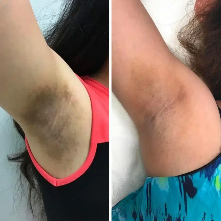 Gel exfoliante aclarante